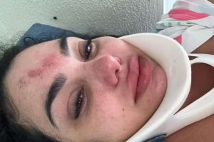 Acidente em piscina: mulher sofre fratura cervical em Capão da Canoa