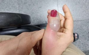 Mulher quase perde dedo e passa por 4 cirurgias após fazer as unhas